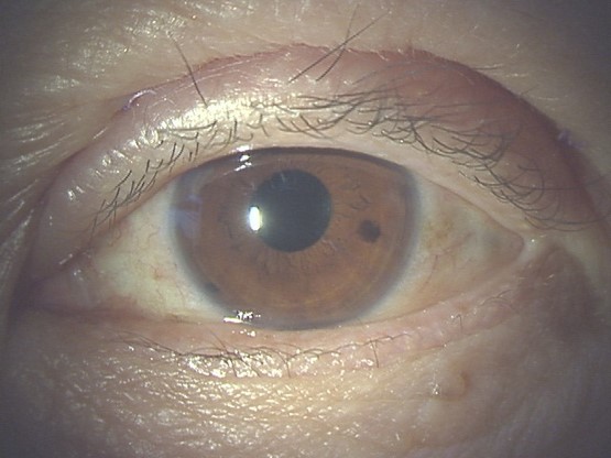 眼瞼下垂症手術