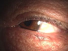 眼瞼内反症手術
