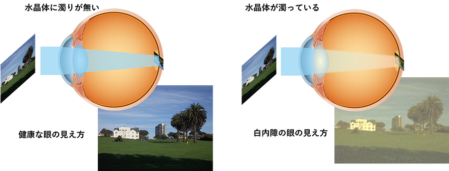 水晶体に濁りが無い健康な目の見え方と水晶体が濁っている白内障の目の見え方の比較画像