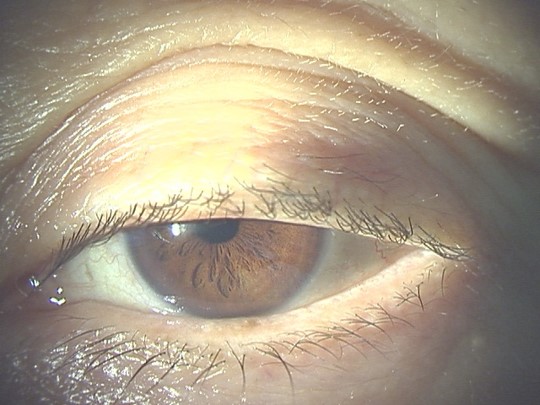 眼瞼下垂症手術